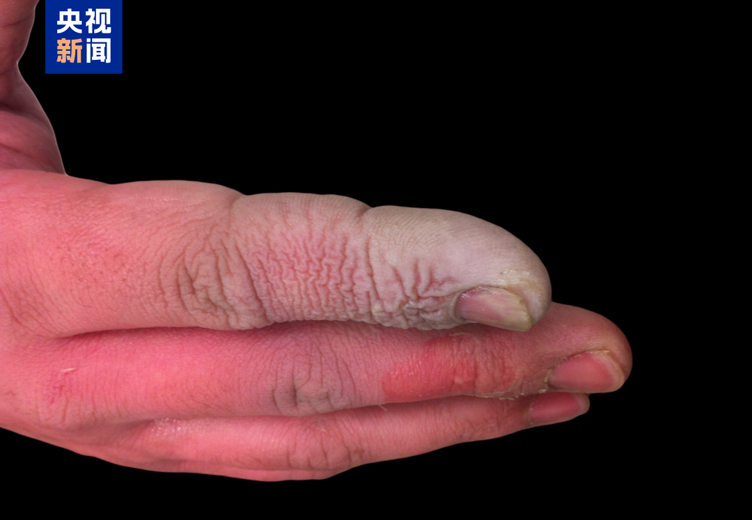 接觸了氫氟酸的手部